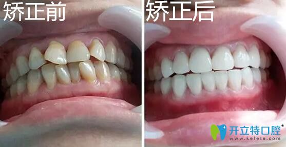 戴隱適美極速版牙套矯正牙齒不齊的