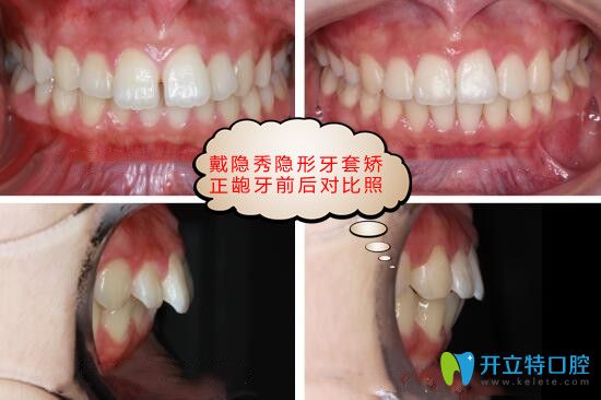 隱秀隱形牙齒矯正好嗎