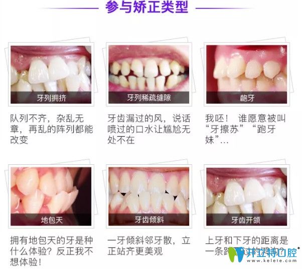 <!--<i data=20240703-sp></i>-->永華口腔矯正類型