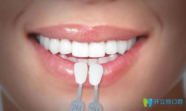 深圳格倫菲爾超薄瓷貼面