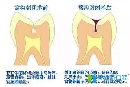 窩溝封閉 窩溝封閉