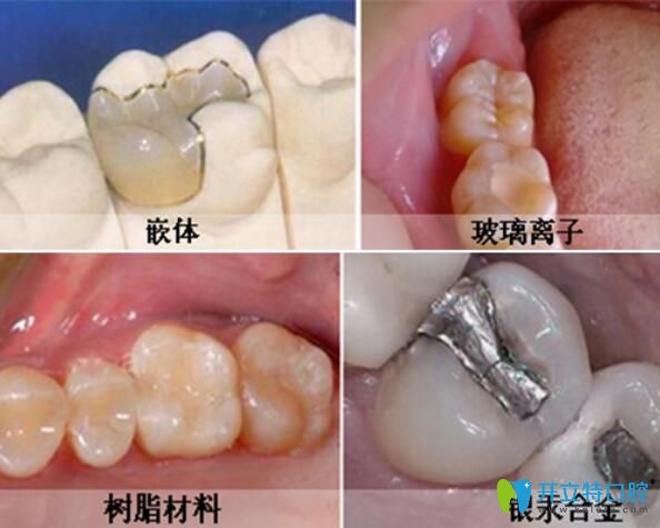 細說高嵌體和牙冠的區(qū)別看看哪個貴,補牙選不對再貴也白費