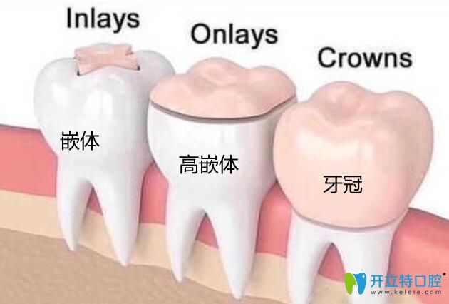 高嵌體和牙冠的區(qū)別