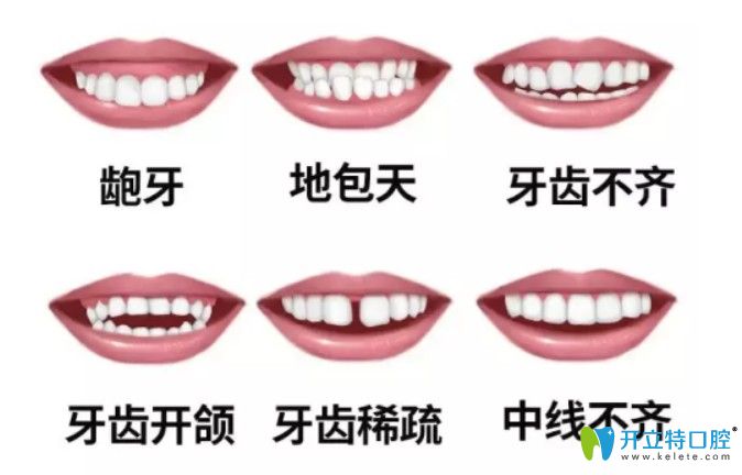 牙齒畸形圖