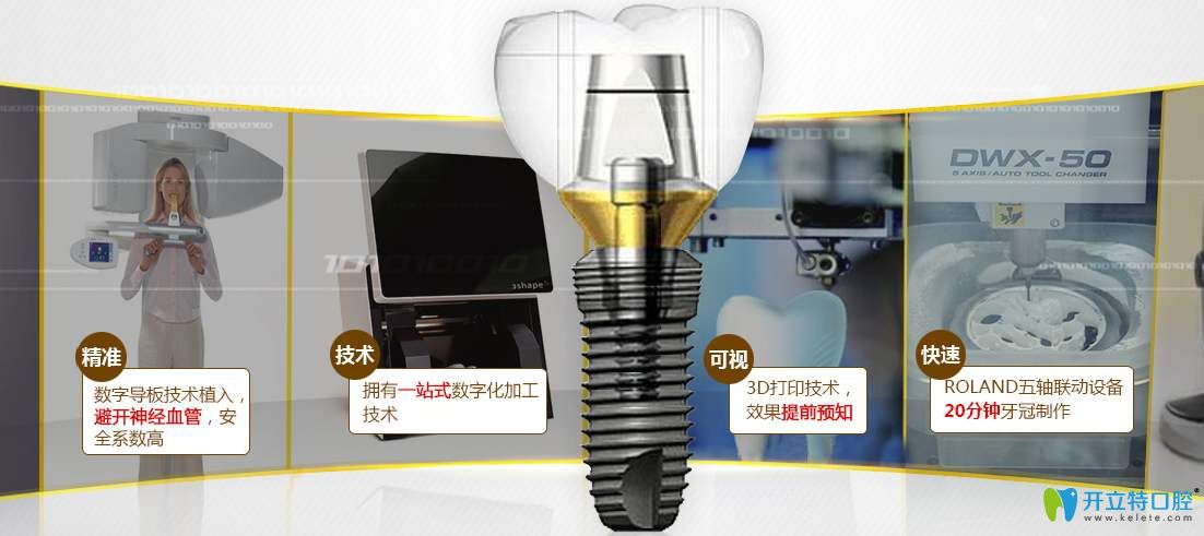 數(shù)字化種植牙 數(shù)字化種植牙
