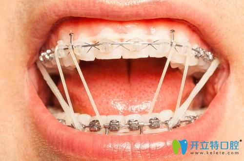 what？有人疑惑正畸橡皮筋吃飯刷牙時還得拿下來么