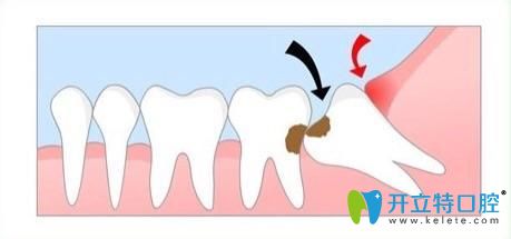 矯正時(shí)候需要拔掉齲齒 矯正時(shí)候需要拔掉齲齒