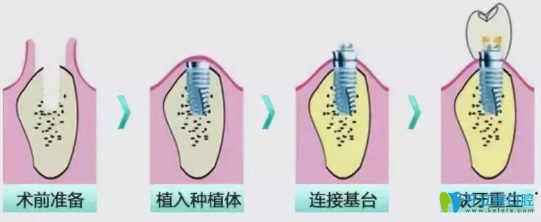 即拔即種和種植牙的區(qū)別,其實是對的時機(jī)遇見對的牙齒條件