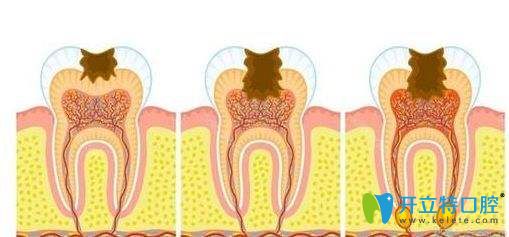 牙髓病的發(fā)展