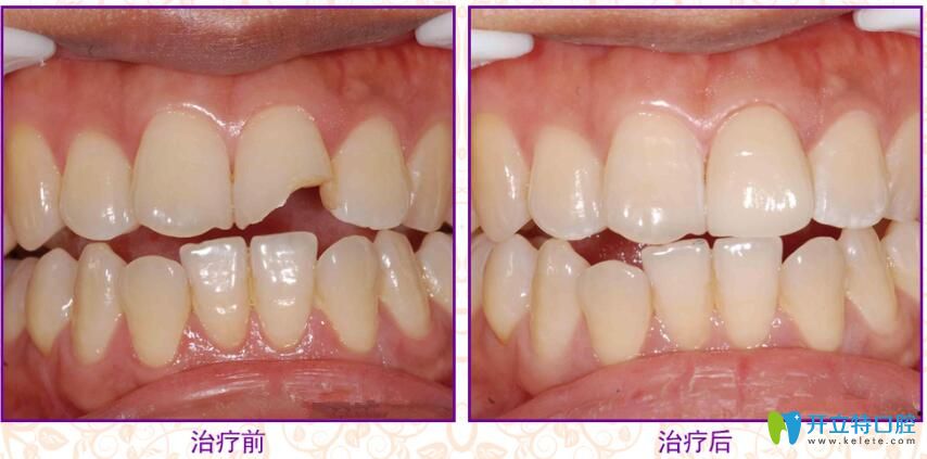 牙齒缺了一半補(bǔ)后圖片