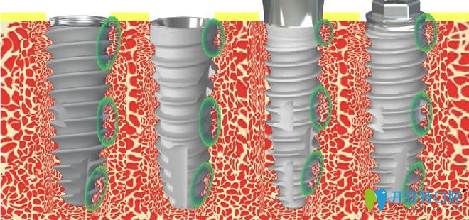 韓國neo種植體缺點(diǎn)