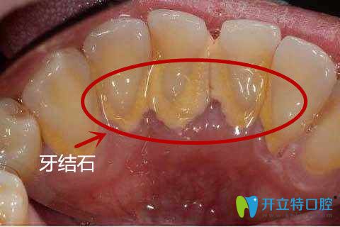 牙結(jié)石圖示