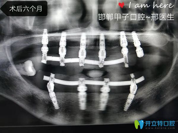 劉阿姨術(shù)后6個(gè)月片子 劉阿姨術(shù)后6個(gè)月片子