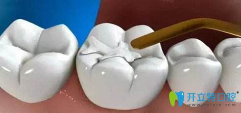 只需要一次治療就可以補(bǔ)好牙