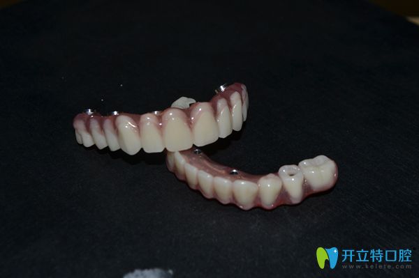 牙冠圖示 牙冠圖示