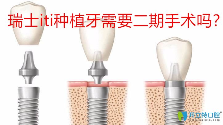 還以為瑞士iti種植牙需要二期手術(shù)呢,那就大錯(cuò)特錯(cuò)了