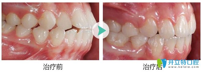 <!--<i data=20240703-sp></i>-->口腔隱適美齙牙矯正前后對(duì)比效果圖