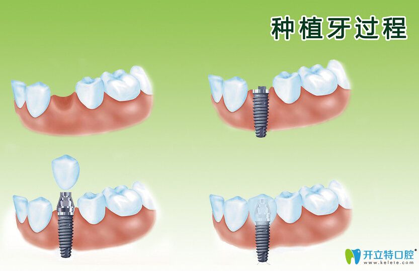 種植牙過(guò)程圖示