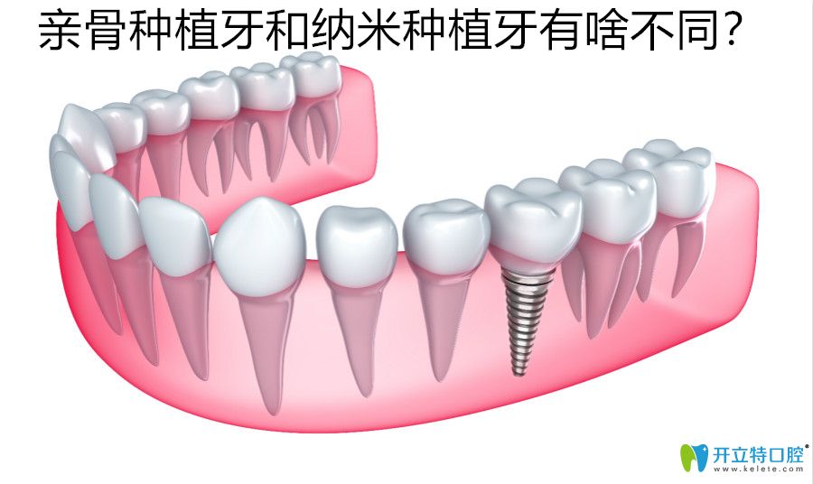 這里有親骨種植牙和納米種植牙的不同點,你知道幾個區(qū)別呢