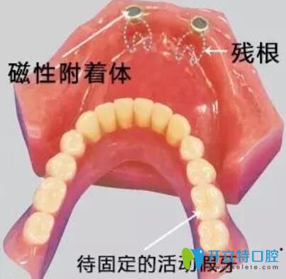 磁性附著體式覆蓋義齒