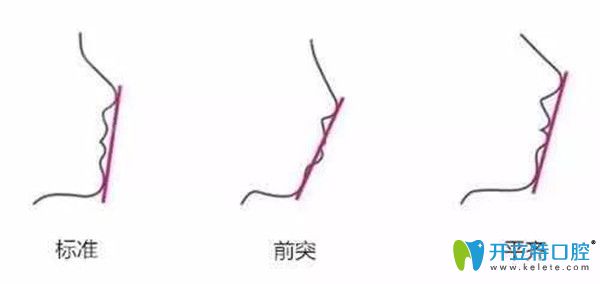 咬合不正常會導(dǎo)致臉型不好看