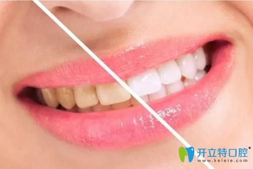 牙齒美白對比示意圖