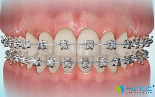 維樂口腔金屬托槽矯正