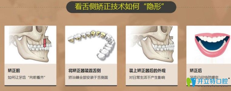 舌側(cè)隱形牙齒矯正的價(jià)格
