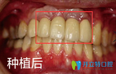 我在晉江修大夫口腔做韓國(guó)種植牙后效果