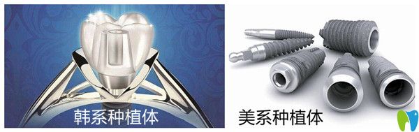 韓系種植體和美系種植體