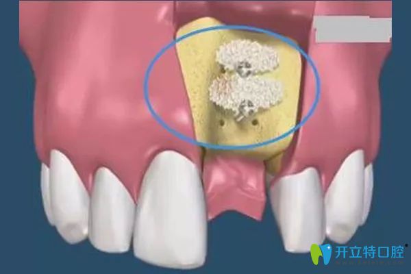 <!--<i data=20240703-sp></i>-->口腔任猛醫(yī)生科普做種植牙為啥要種骨粉 <!--<i data=20240703-sp></i>-->口腔任猛醫(yī)生科普做種植牙為啥要種骨粉