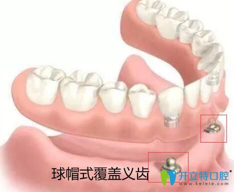 價格吊打種植牙的全口覆蓋義齒修復到底有哪些優(yōu)缺點？