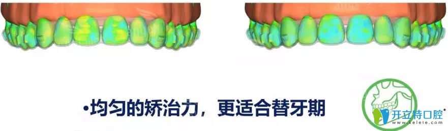 時(shí)代天使kid矯正均勻的矯治力度