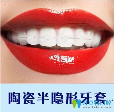 重慶維樂(lè)口腔陶瓷半隱形牙套