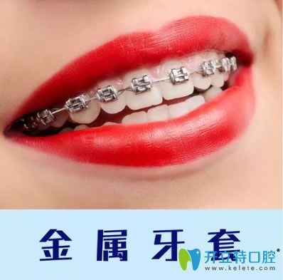 重慶維樂(lè)口腔金屬牙套