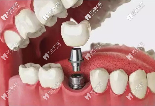 做種植牙的好處
