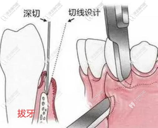 小姐姐親身經(jīng)歷了超聲骨刀拔橫生智齒后說(shuō)比普通拔牙好