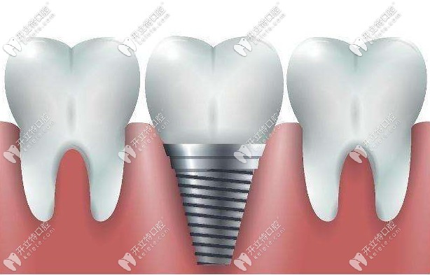 博愛種植牙活動時間及細(xì)則