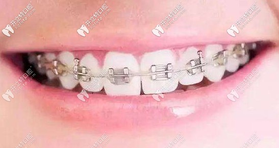 圣貝口腔金屬矯正