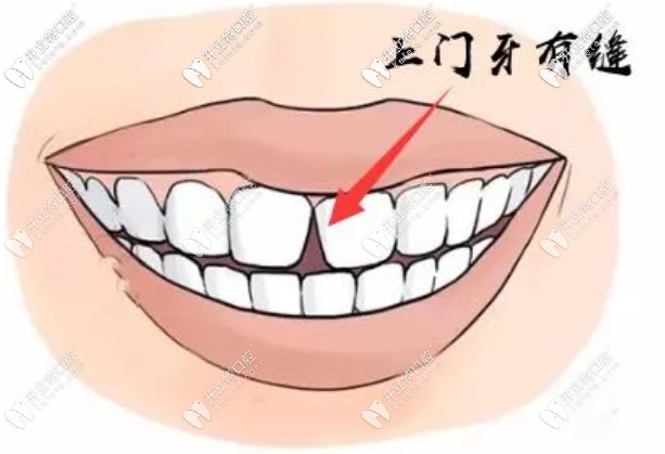 都有哪些原因導致牙縫變大