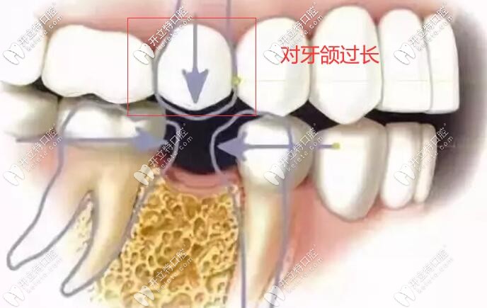 對(duì)面牙齒過長,上下咬合空間不夠怎么做種植牙?