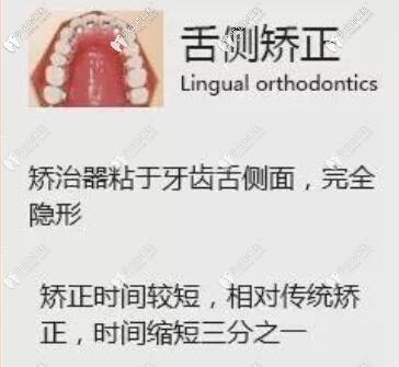 舌側矯正優(yōu)點