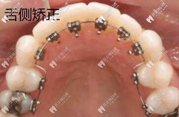 舌側矯正圖片