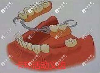 局部 卡環(huán)活動義齒