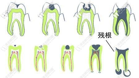 拿什么拯救你20幾年沒拔的牙齒殘根,不拔掉會(huì)怎么樣