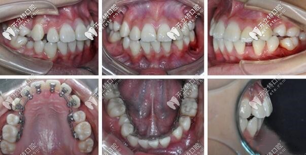 舌側(cè)隱形牙套矯正齙牙效果