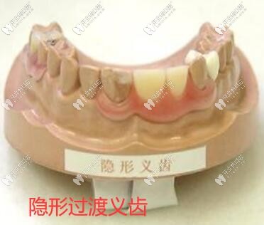 想安裝種植過渡義齒先弄清什么時候佩戴比較合適