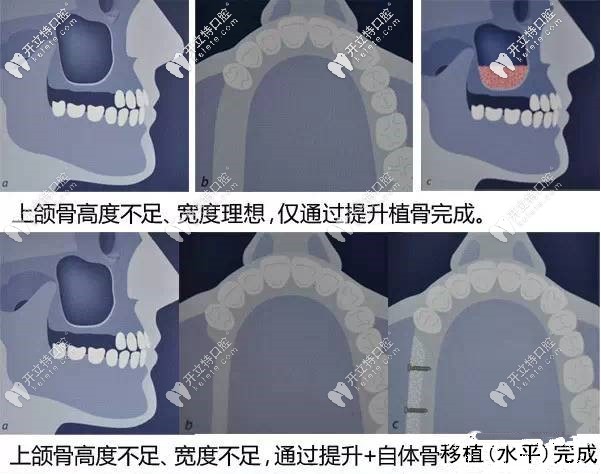 上頜竇提升術(shù)的原理