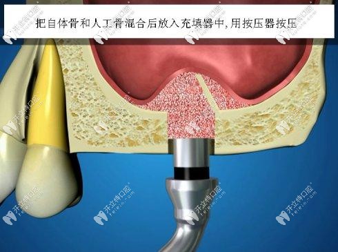上頜竇內(nèi)提升術(shù)植入骨粉