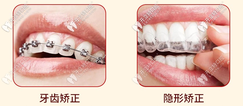 牙齒矯正活動(dòng)